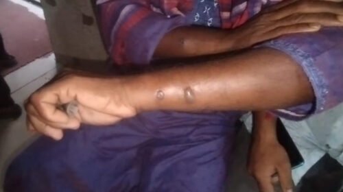 গাইবান্ধায় ১১ জনের শরীরে অ্যানথ্রাক্সের উপসর্গ